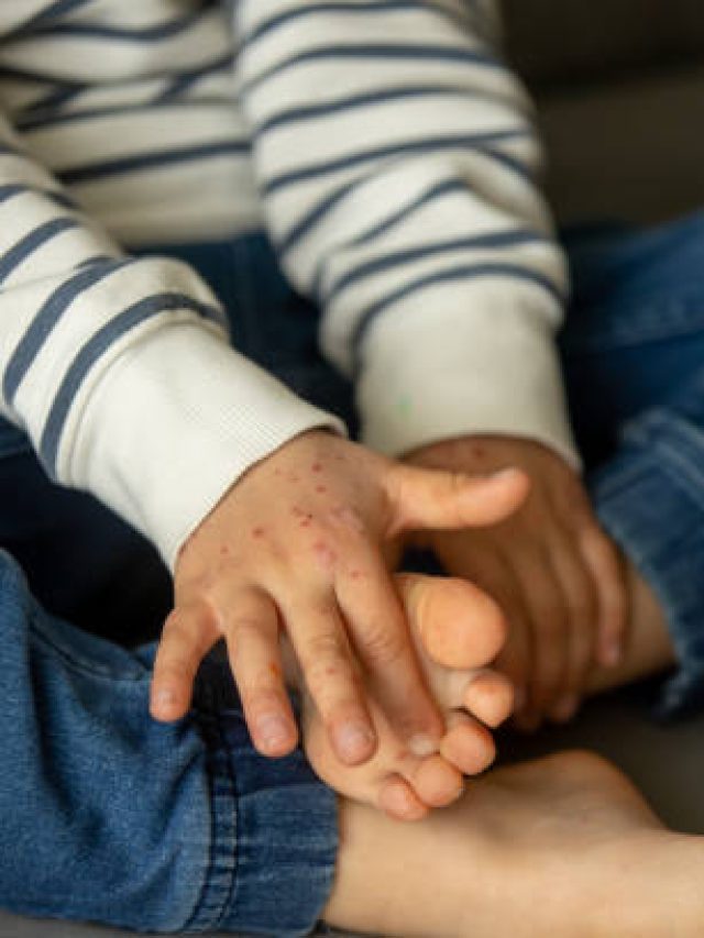 Síndrome Mão-Pé-Boca: Entenda o que é e como prevenir